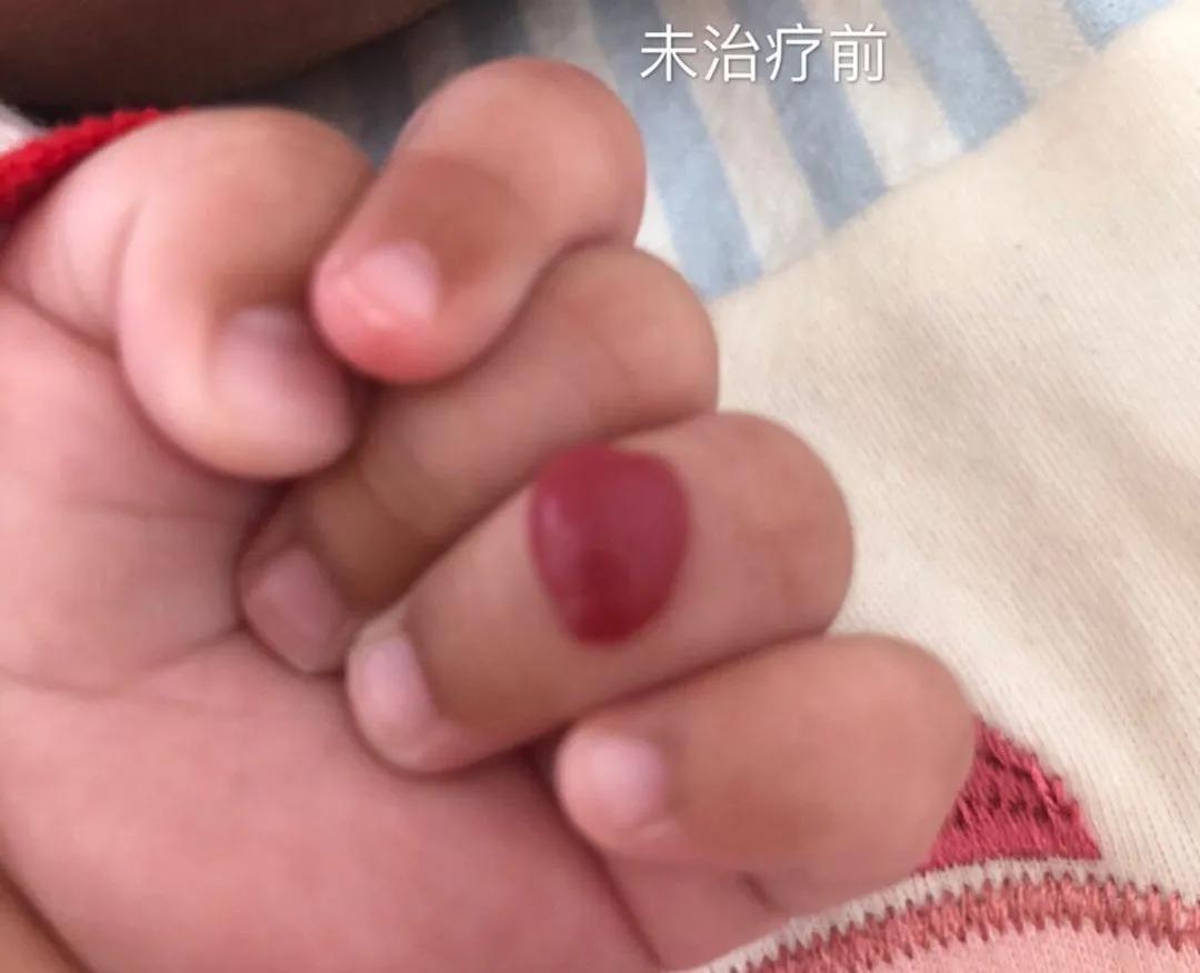 宝宝手指血管瘤治疗方法,手指头上长了个血管瘤怎么治疗