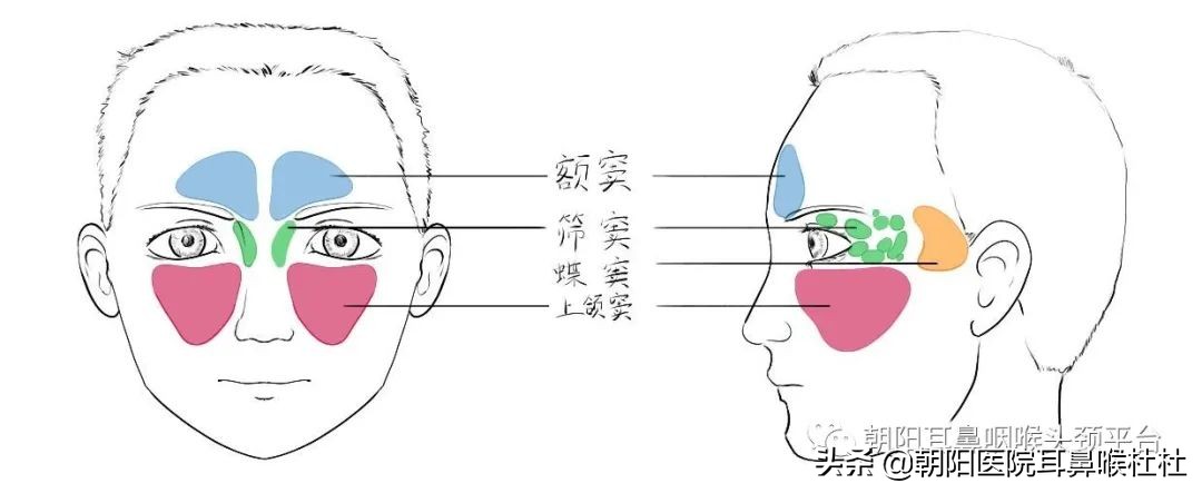 急性鼻窦炎头痛早上轻午后重,头痛鼻窦炎
