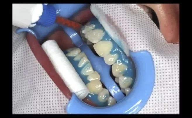 牙齿总是黄黄的？唯美口腔教你2个靠谱方法美白牙齿