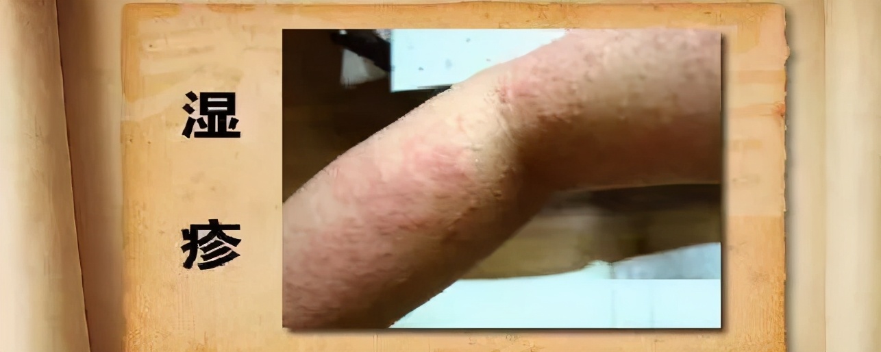 皮肤病反反复复要如何调理,皮肤病反反复复中药如何治疗