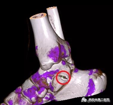 痛风影像技术,痛风石电镜