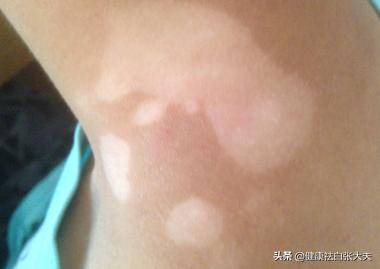 小伙的“悲哀”：春风得意马蹄疾，一日晒出『白癜风』