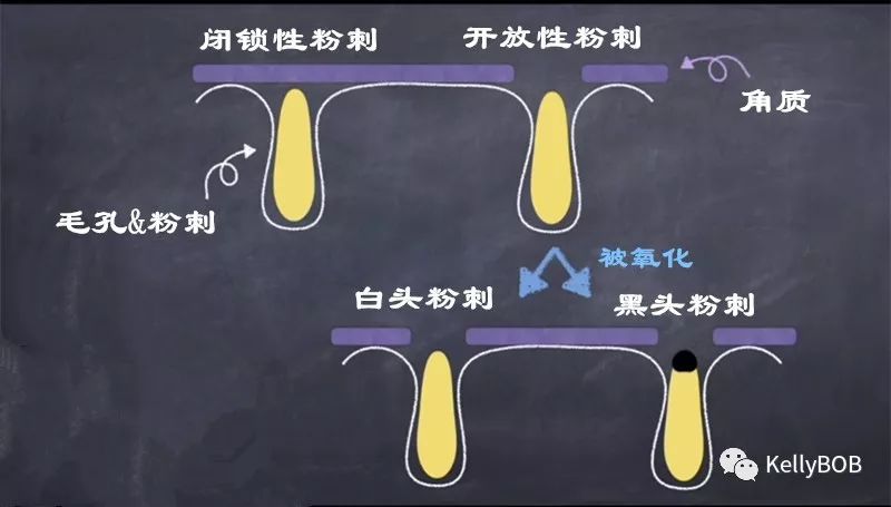 痘痘肌怎么去除粉刺和痘印,如何拯救痘痘肌肤再也不长痘痘