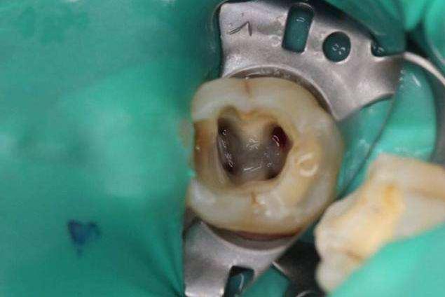 为什么根管治疗后牙齿断裂,根管治疗后的牙怎么做牙冠