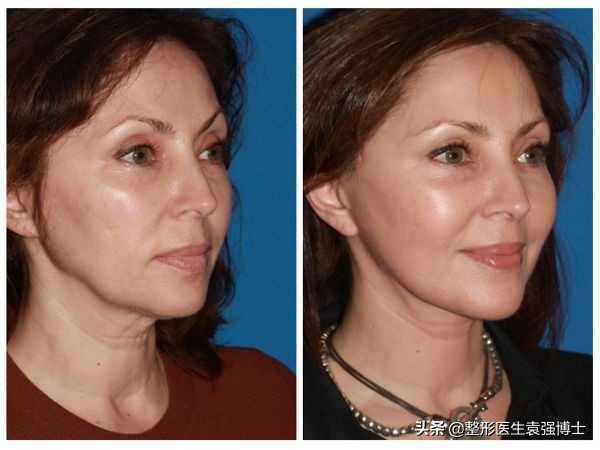 拉皮手术的四大优势,拉皮手术热议