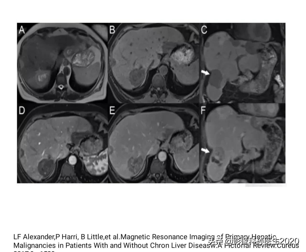 肝上皮样血管内皮瘤全国多少例,肝上皮样血管内皮瘤超声表现