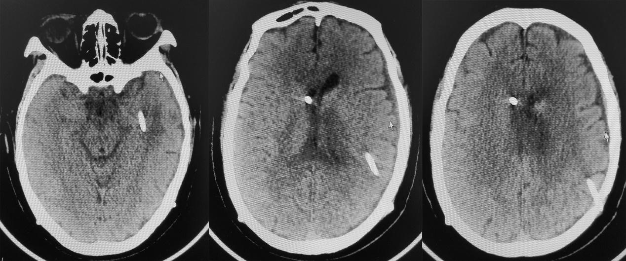 脑脓肿合并脑膜炎需要手术吗,脑脓肿进入左侧脑室严重吗
