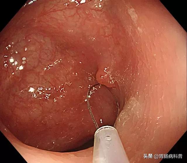 长胃息肉要注意什么,胃长息肉要注意什么