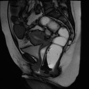 孕中期漏尿是盆底肌受损吗,产前漏尿需要做盆底肌修复吗