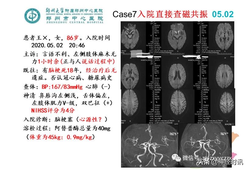 静脉溶栓怎么引起的,静脉相关并发症的预防及处理