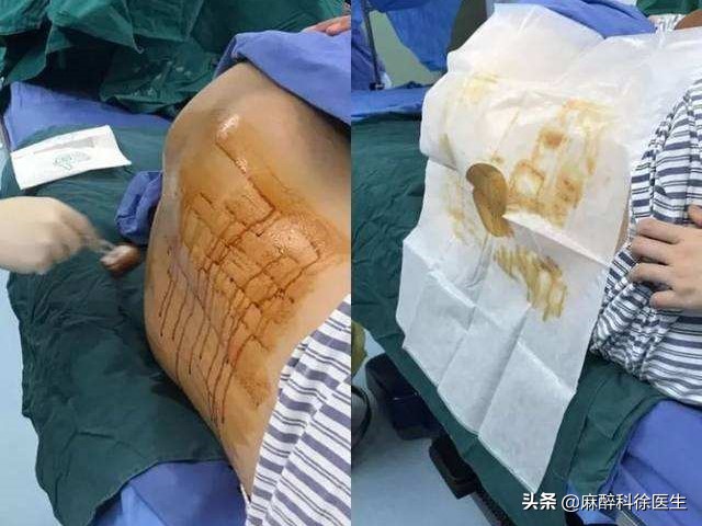 麻醉就是麻醉什么感觉,麻醉师讲的是什么