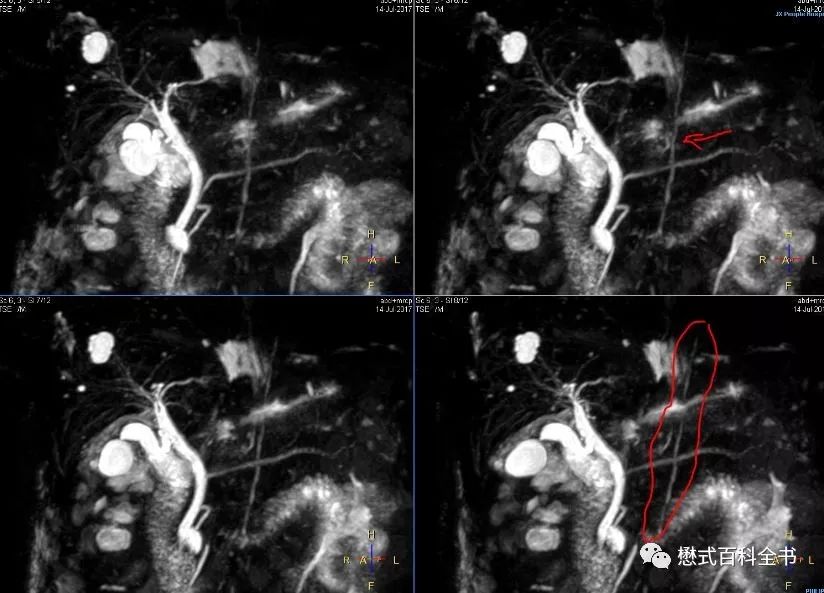 开展mrcp技术,mrcp检查操作流程