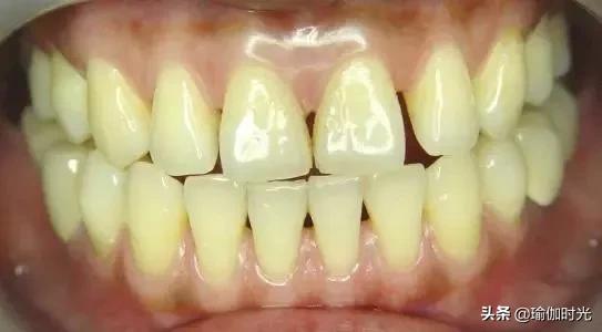 美白净齿牙膏去黄牙,牙齿美白除口臭牙膏修正