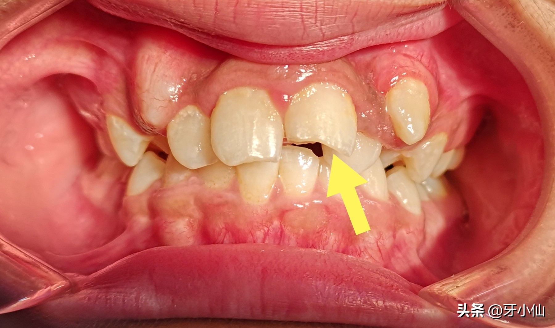牙太痛,吃不了热辣火锅、冰爽雪糕、酸甜水果,怎么能当吃货?