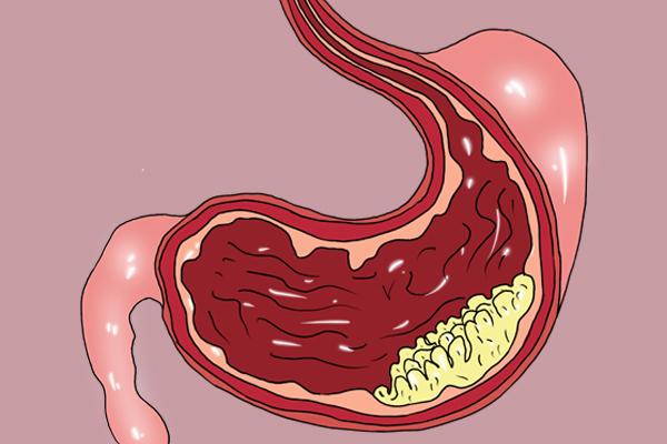 胃病别拖胃炎到胃癌只需4步,从慢性胃炎到胃癌最快多久