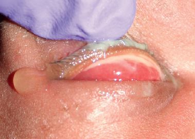 宝宝眼睛红是红眼病吗,新生宝宝眼睛红