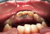 牙齿发黑是什么原因,宝宝牙齿发黑了怎么办