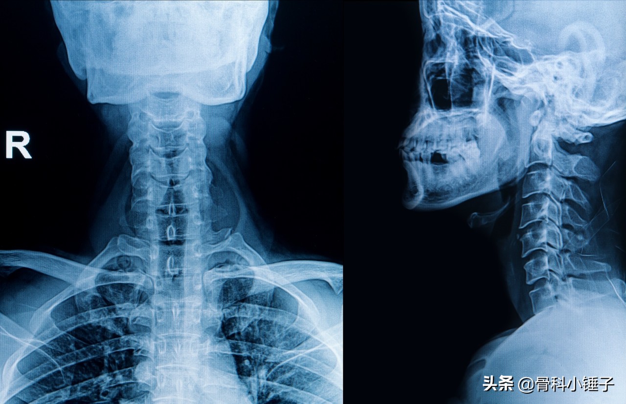 神经性颈椎病开刀手术效果好吗,神经型颈椎病微创手术要多久