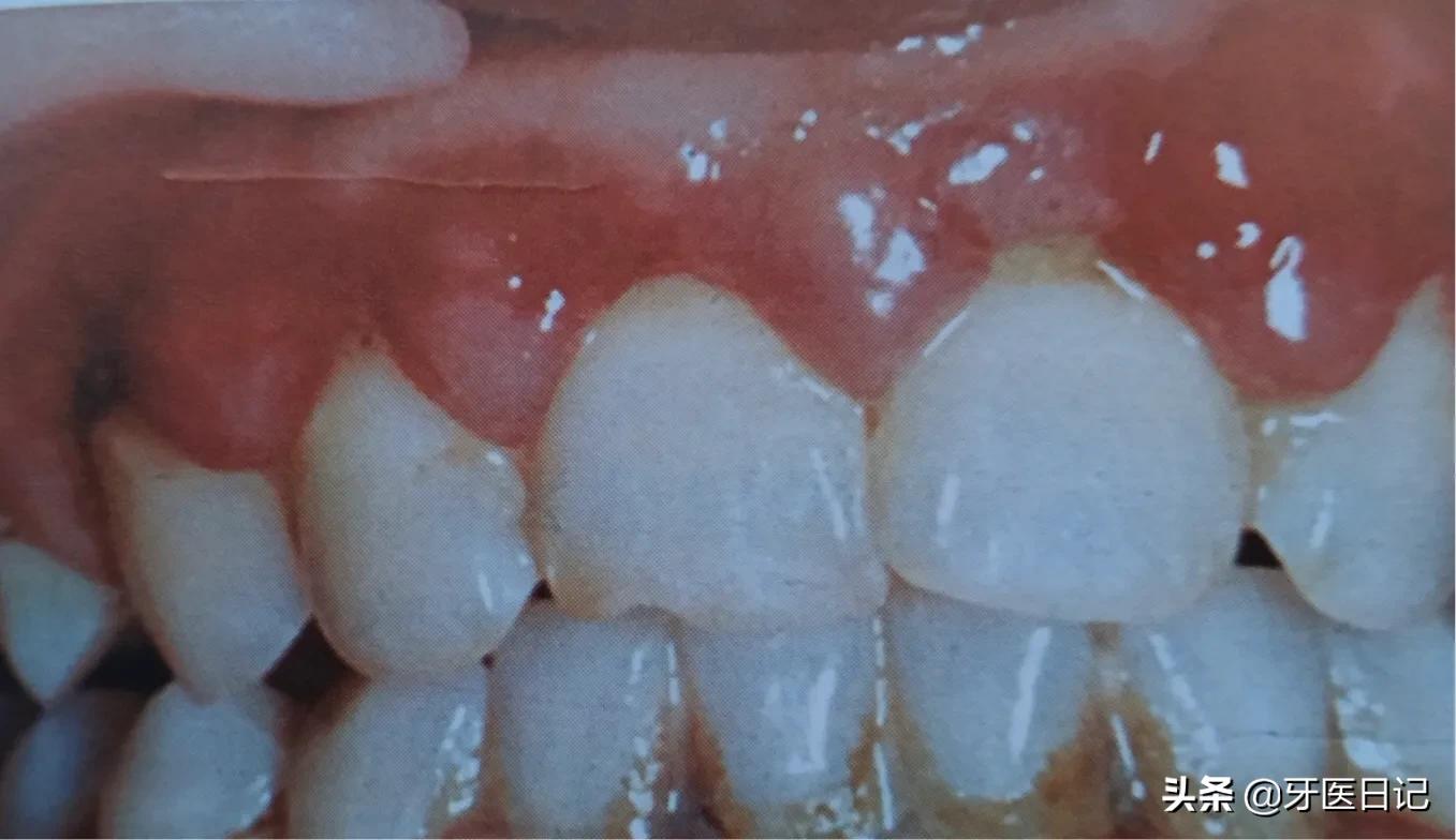 牙龈又红又肿，上火了吗？