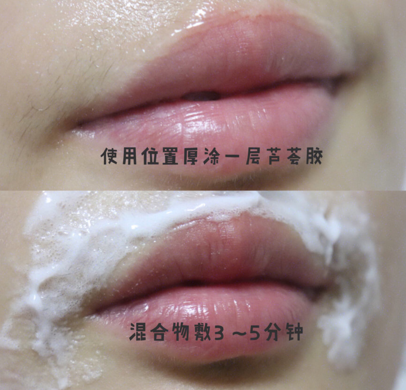 如何去除唇周小胡子,小胡子唇周黑怎么去除