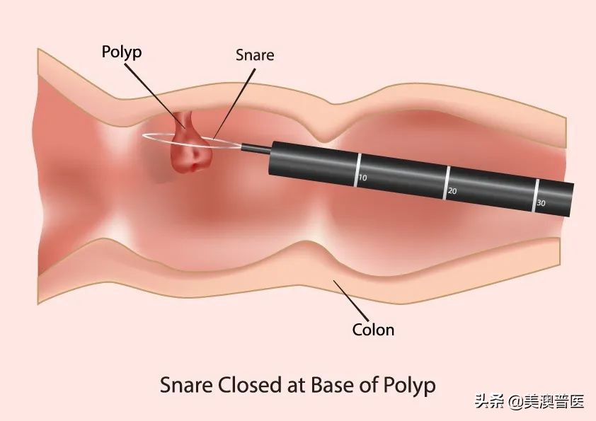 肠息肉大于2cm可以肠镜切除干净吗,肠息肉切除的几种方法