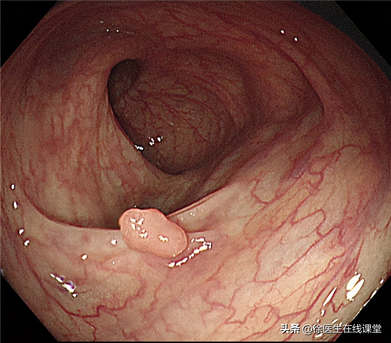 肠息肉到肠癌需要多久？肉眼咋判断是否已癌变？专家为你详细解答