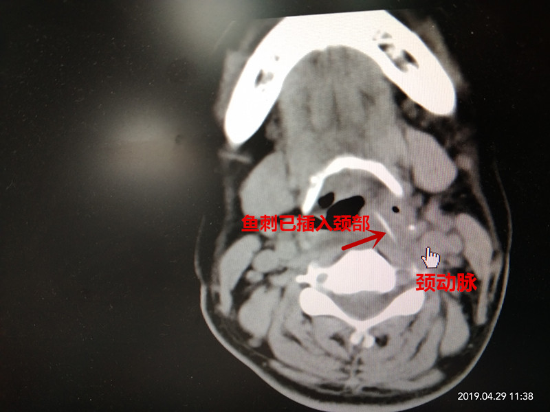 楸煎埡鍗″枆寮曞彂鐢熷懡鍗遍櫓,琚奔鍒哄崱浣忓幓鍖婚櫌鍠夐暅鍙栧埡