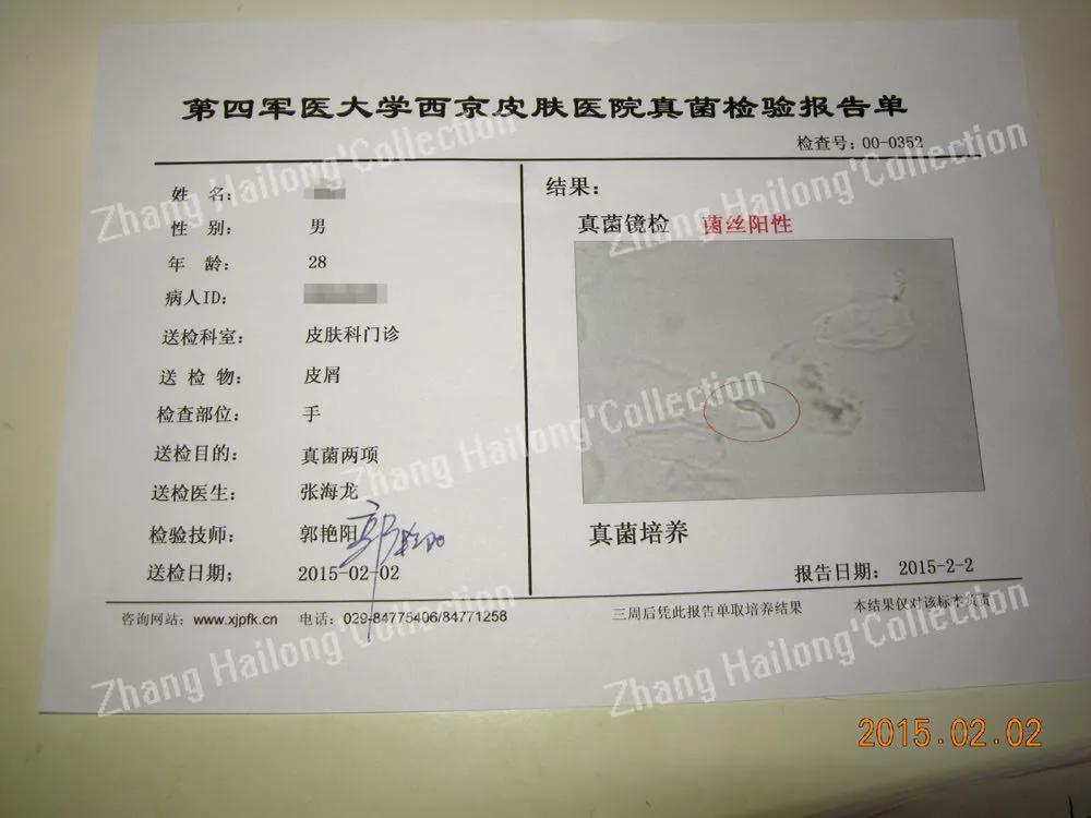 脸上长癣是怎么回事,12岁女孩脸上长癣