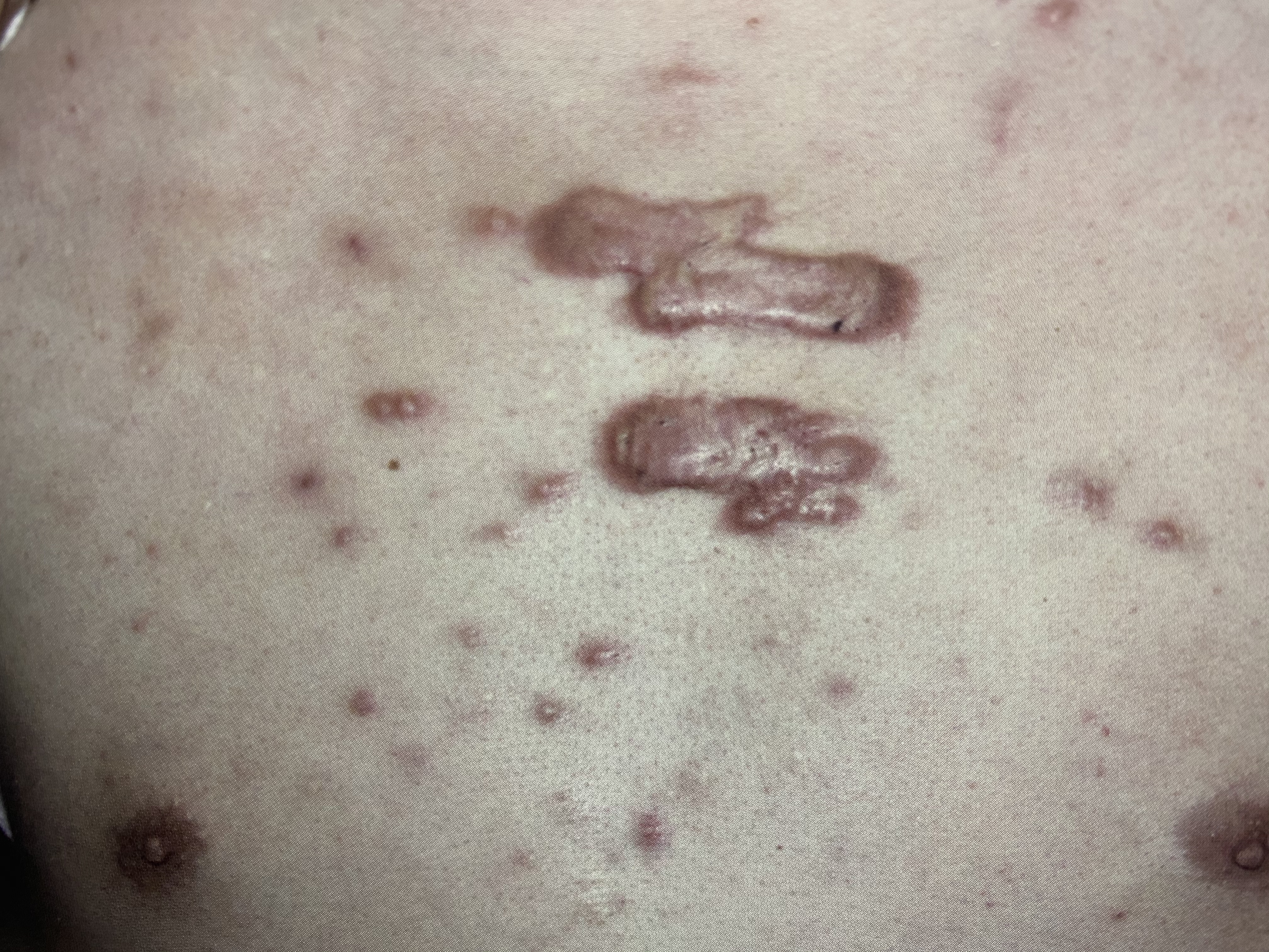 痤疮瘢痕疙瘩最新治疗方法,同位素治疗瘢痕疙瘩痊愈的过程