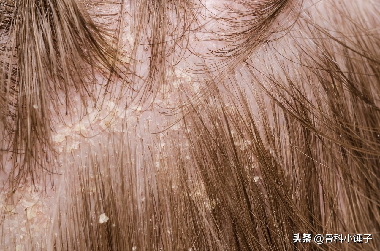 宝宝头皮脂溢性皮炎,鹤叔头皮脂溢性皮炎