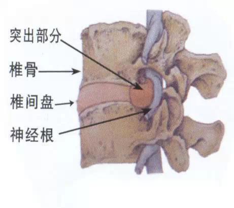 腰椎间盘突出就是脊髓不好了,腰椎间盘突出不是骨头突出