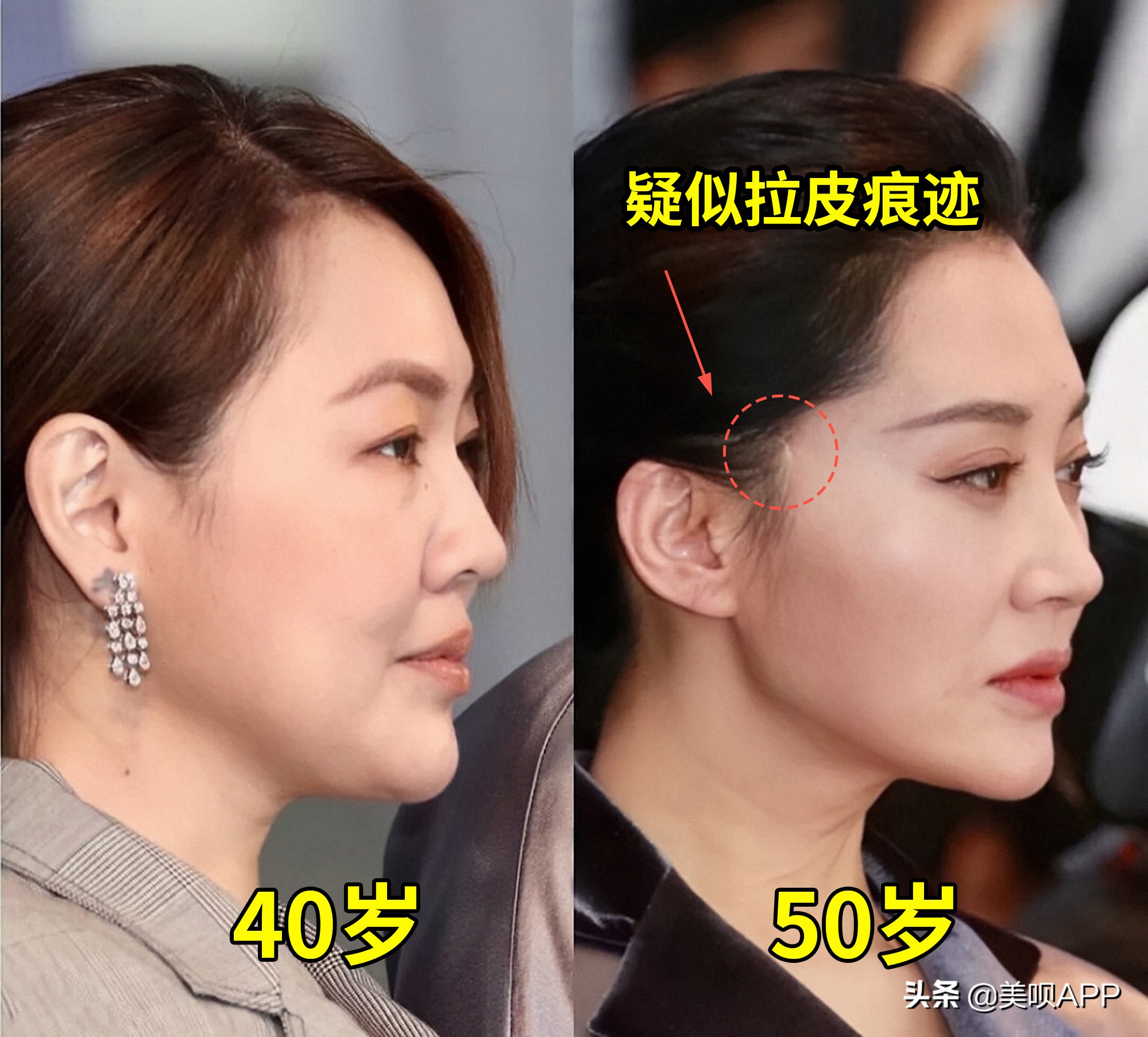 西京医院整形美容科面部年轻化,面部美容年轻化手术科普