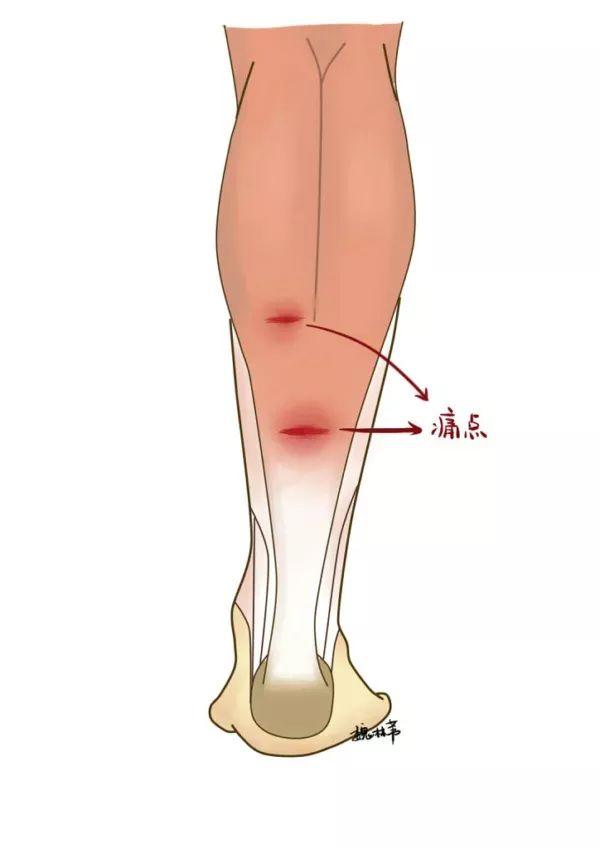 跟腱被踢走路很痛怎么办,感觉小腿肚被踢了一脚