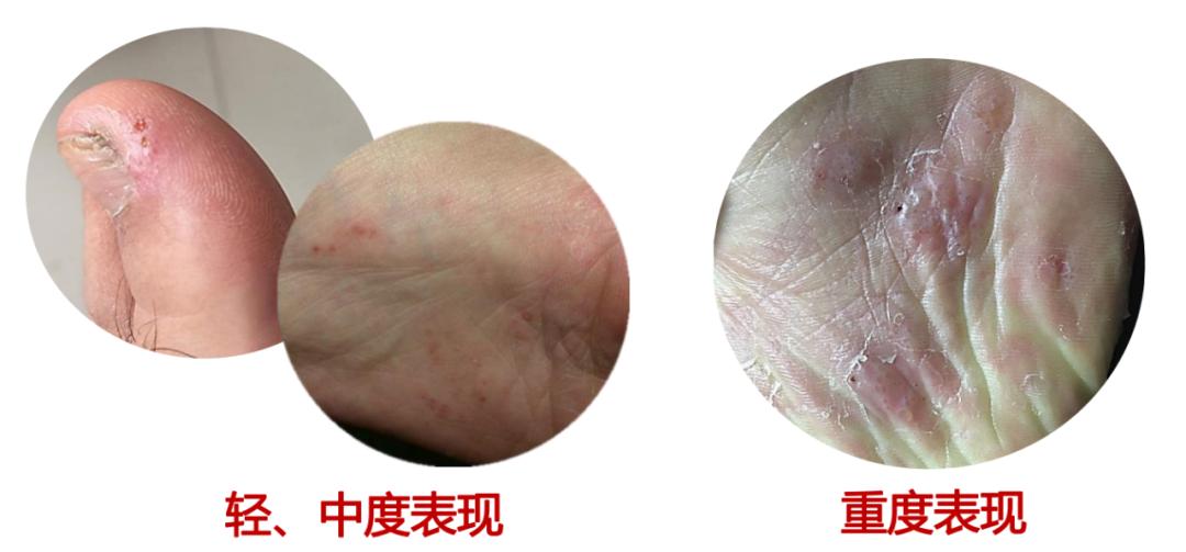 及时治疗脚气，是对家人最好的负责