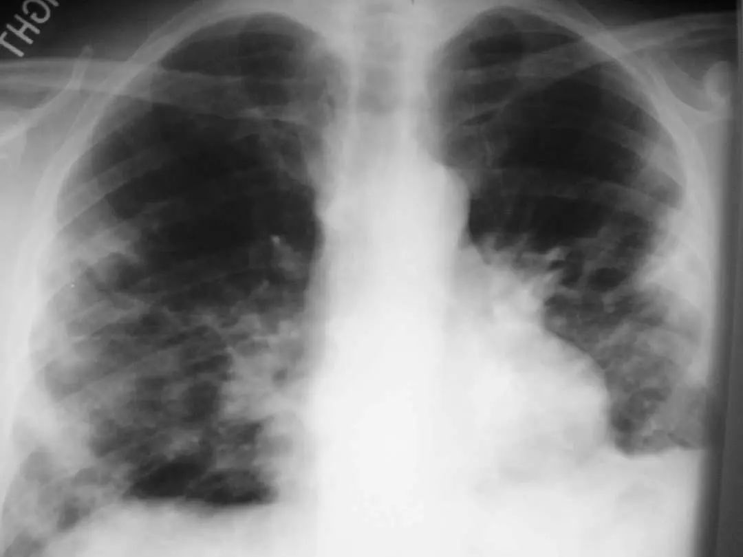 肺炎炎症图片,肺炎病历单图片