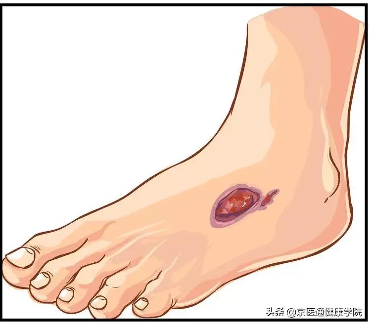 糖尿病最怕「糖尿病足」的出现或加重，专家教你6招巧预防