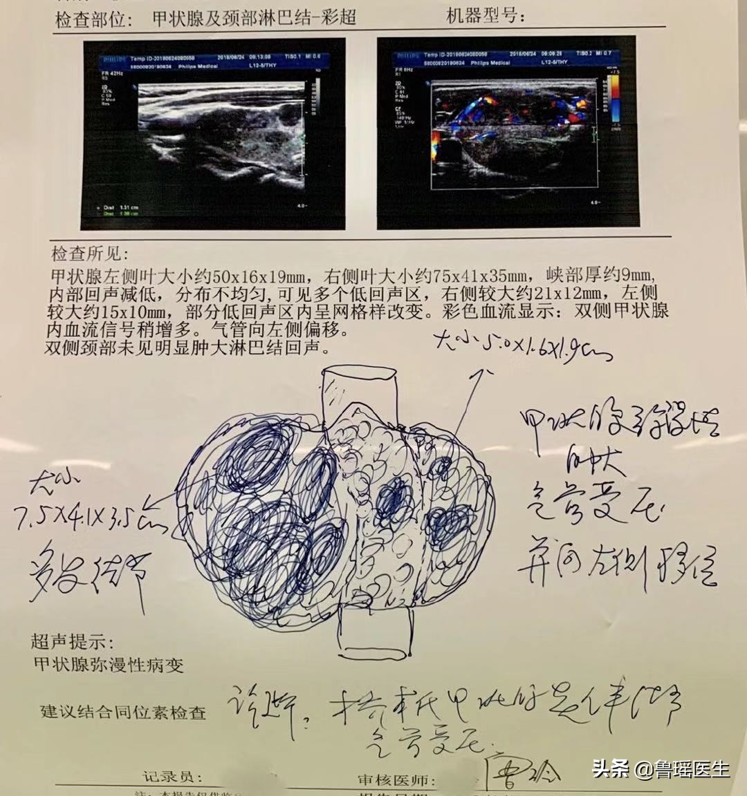 病例分享：桥本氏甲状腺炎是一种什么病？需要手术吗？