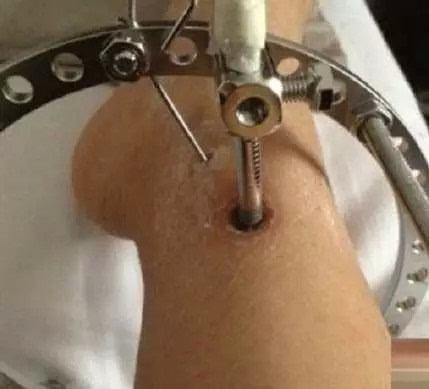 中国有没有断骨增高手术,什么是断骨增高手术