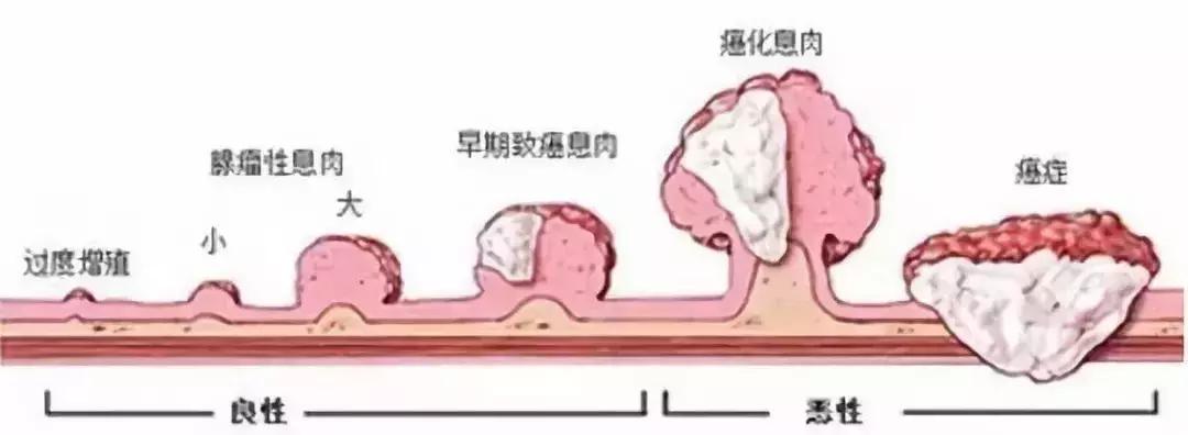 艾灸治息肉的最佳方法,息肉最怕的克星艾灸