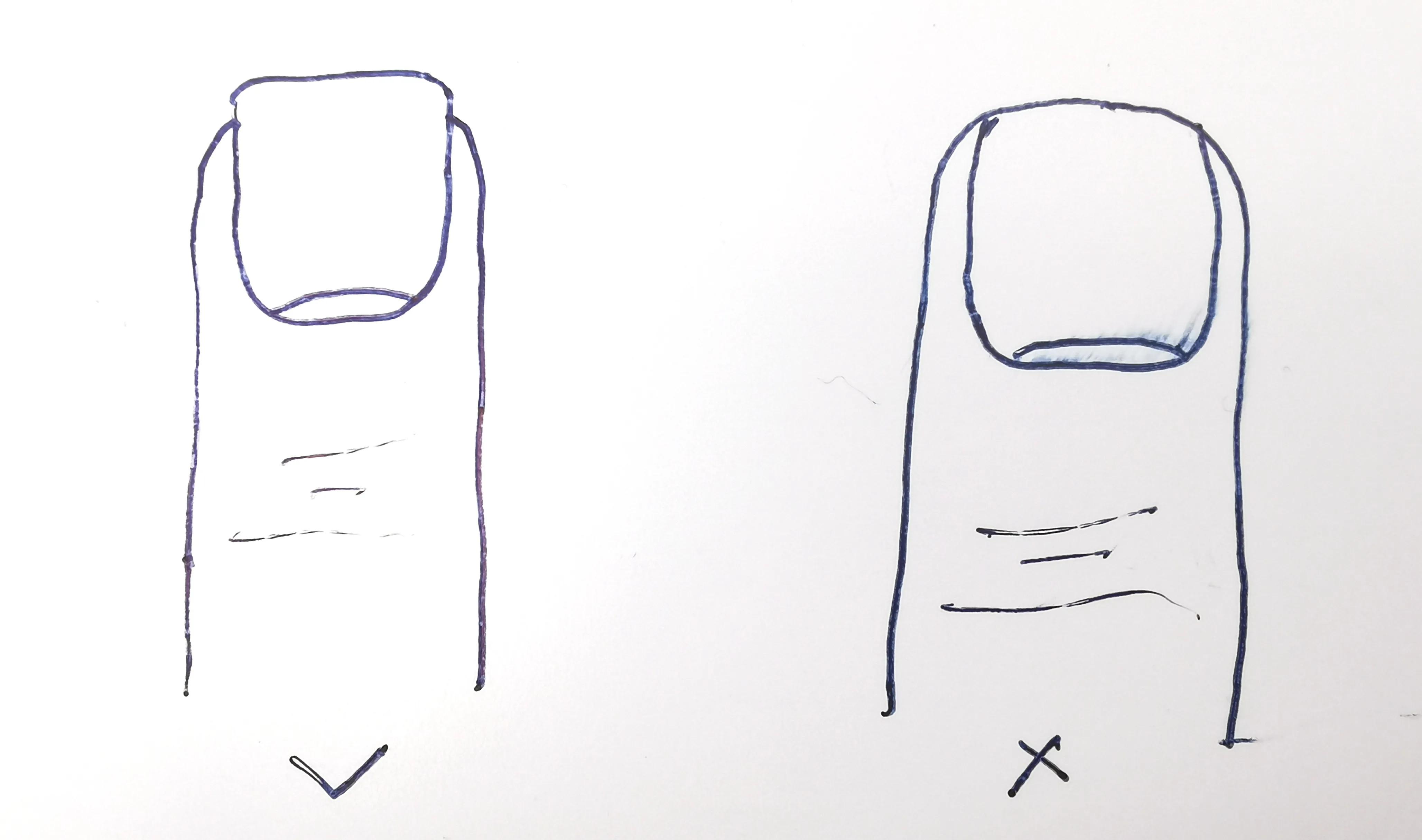 儿童怎么预防甲沟炎,美甲能预防甲沟炎吗