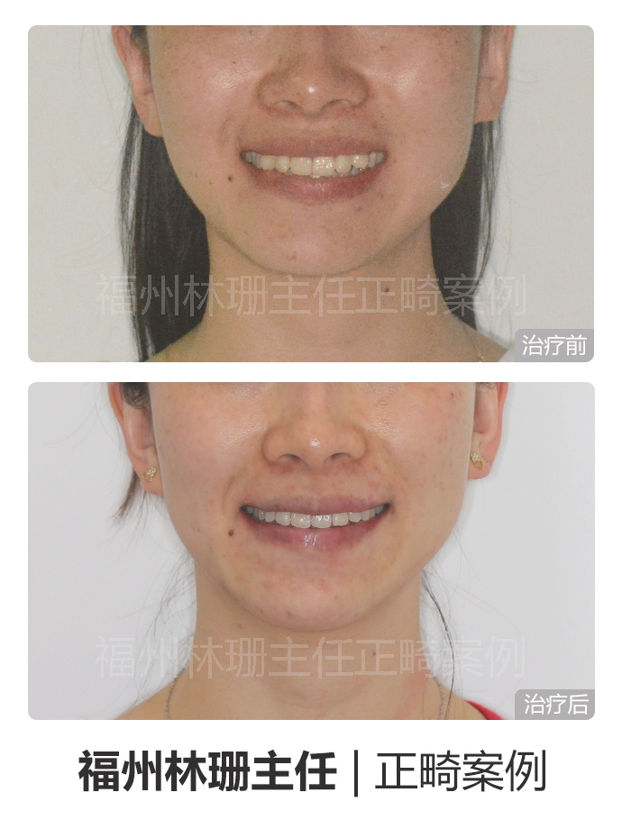 福州晋安哪里矫正牙齿,福州牙齿畸形龅牙矫正