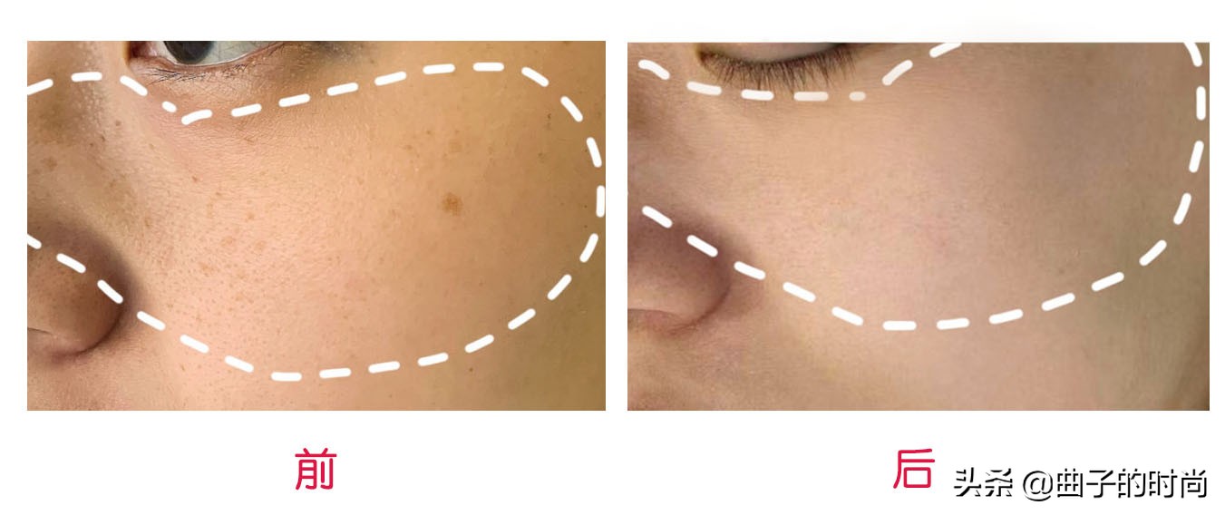 祛斑走过太多的弯路最有效的方法,祛斑最有效方法日晒斑