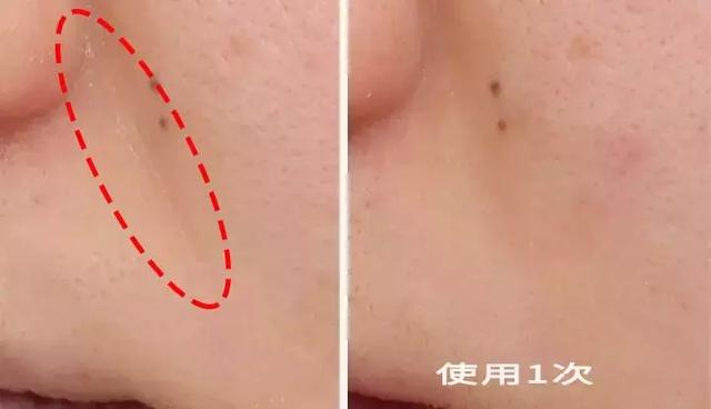 硬刚女皇龙妈也扛不住法令纹，2条沟壑让人心疼，贴一贴就消了