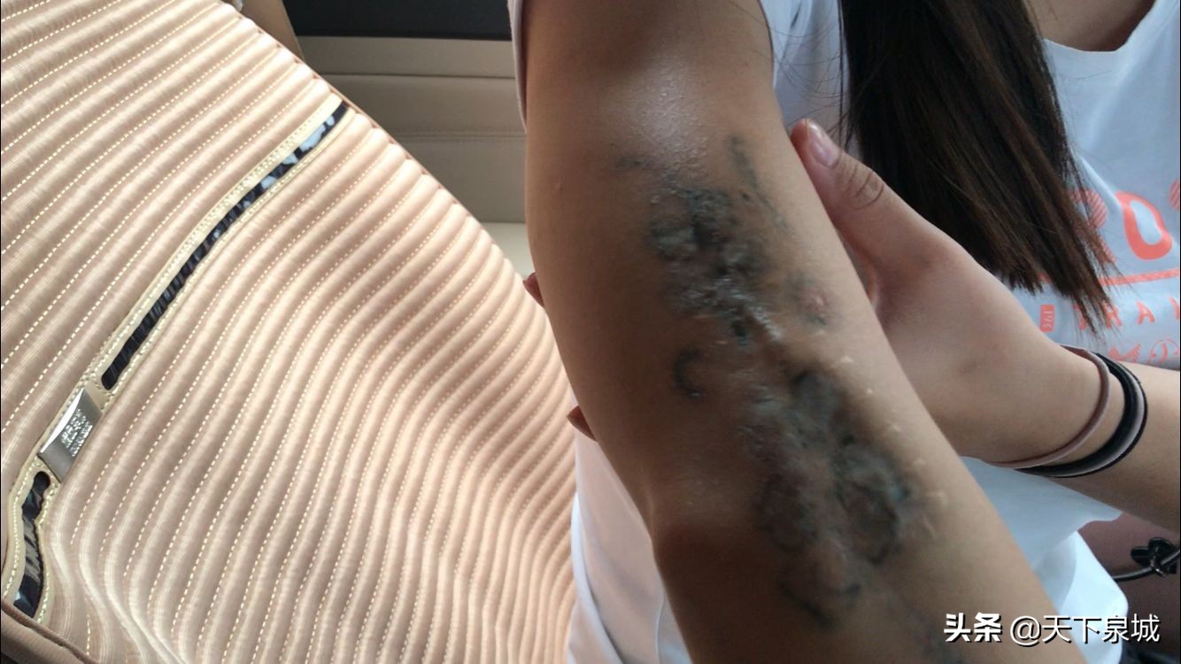 济南华夏医院洗纹身效果怎么样,济南华夏医院洗纹身怎么样