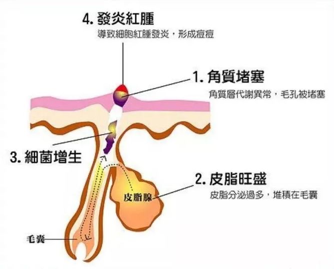 手持挤痘痘神器,挤痘神器单头