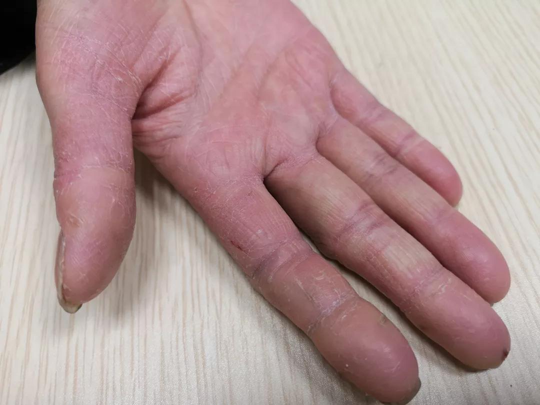 手上脱皮是什么真菌,手上脱皮真菌感染抹什么药膏好