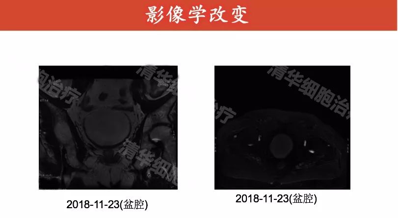 前列腺癌术后psa升高一定是复发吗,前列腺癌术后治疗