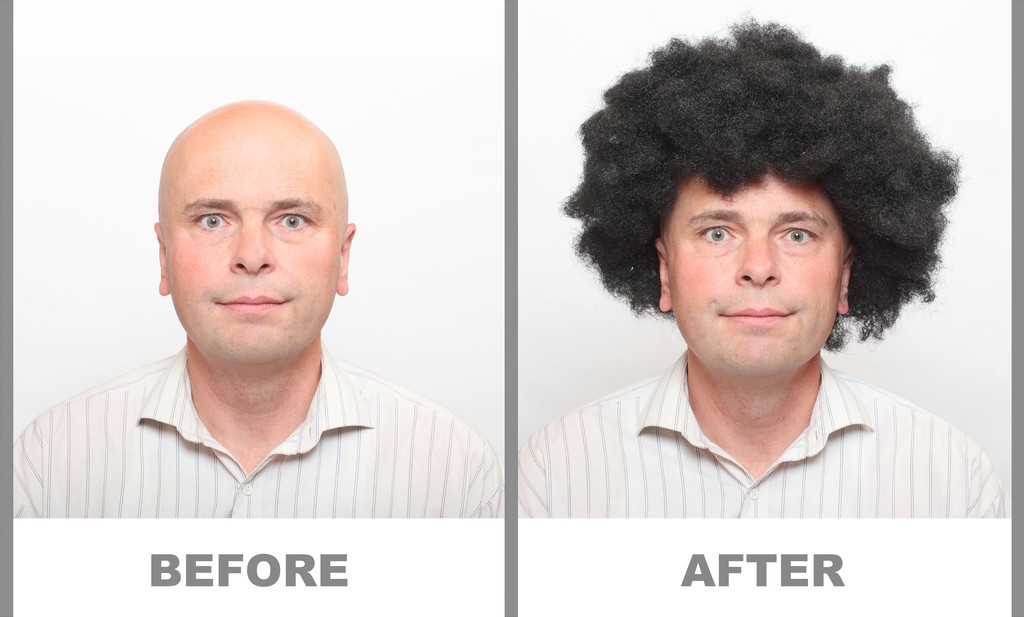 从鬓角开始脱发原因,从头顶部位开始脱发是雄脱吗