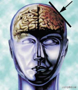 弥漫性轴索损伤和脑干挫伤,弥漫性轴索损伤有必要救吗