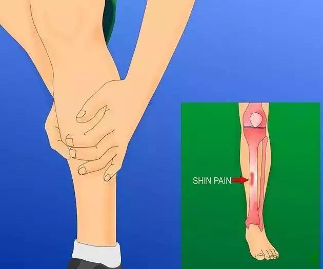 小腿骨膜炎症状有哪些,小腿骨膜炎怎么治疗好得快